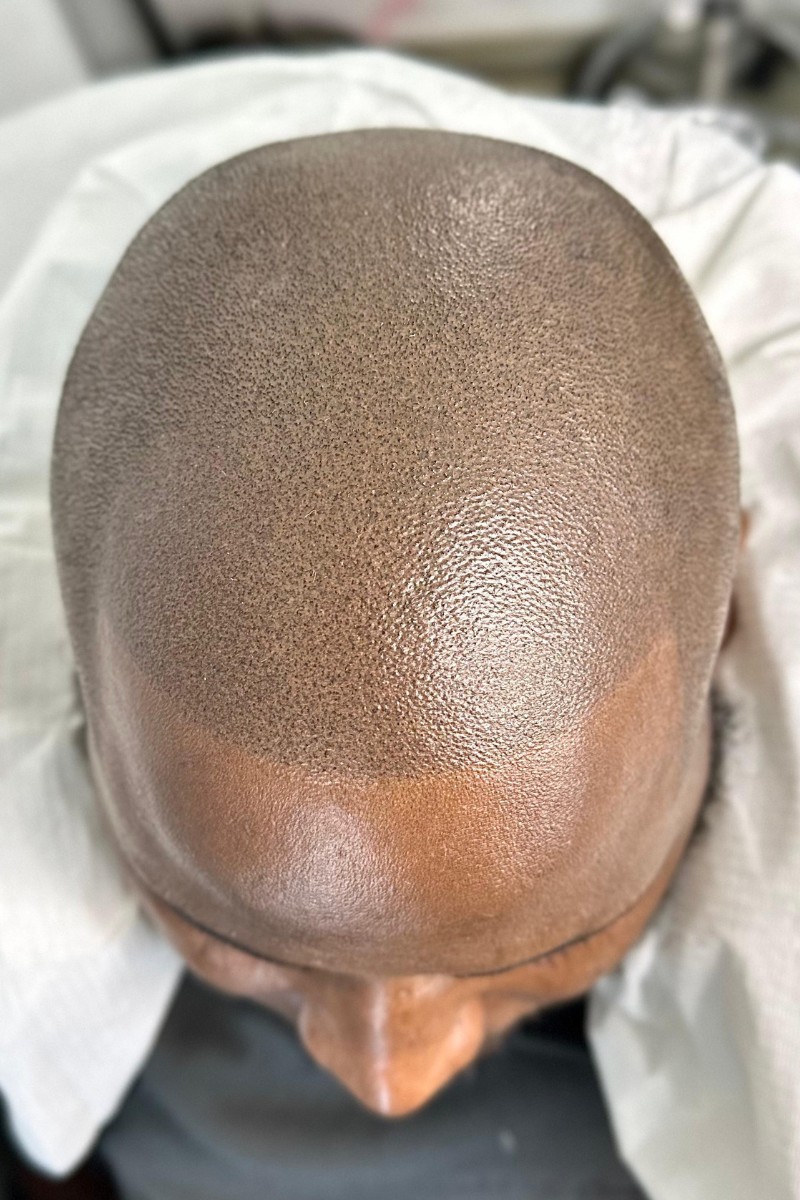 Scalp Micropigmentation The Bomb Aesthetics scalp-micropigmentation-the-bomb-aesthetics