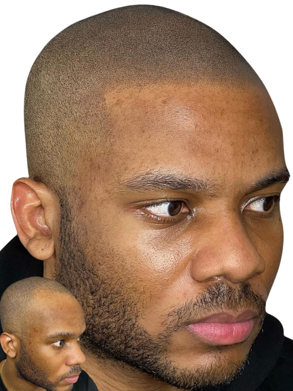 Scalp Micropigmentation