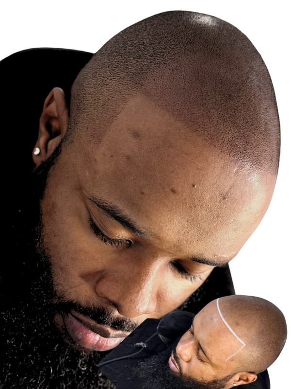Scalp micropigmentation before and after at The Bomb Beauty Aesthetics Sandton