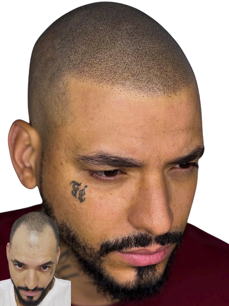 Hair Restoration