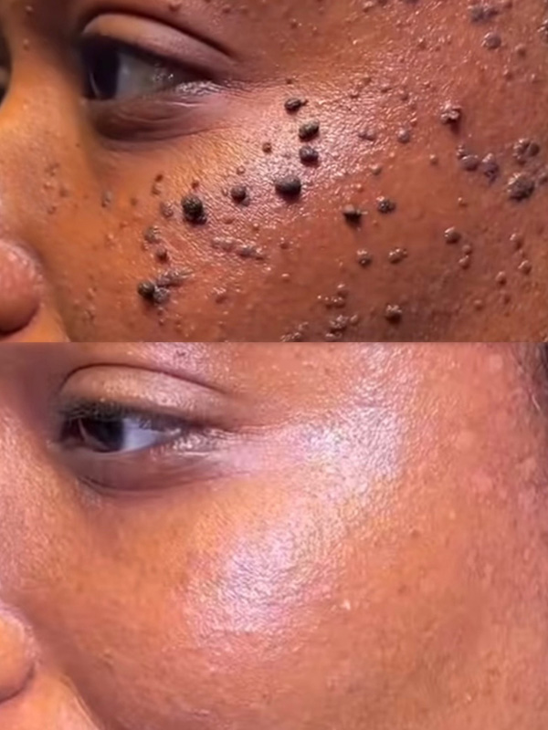 Skin Tag Removal