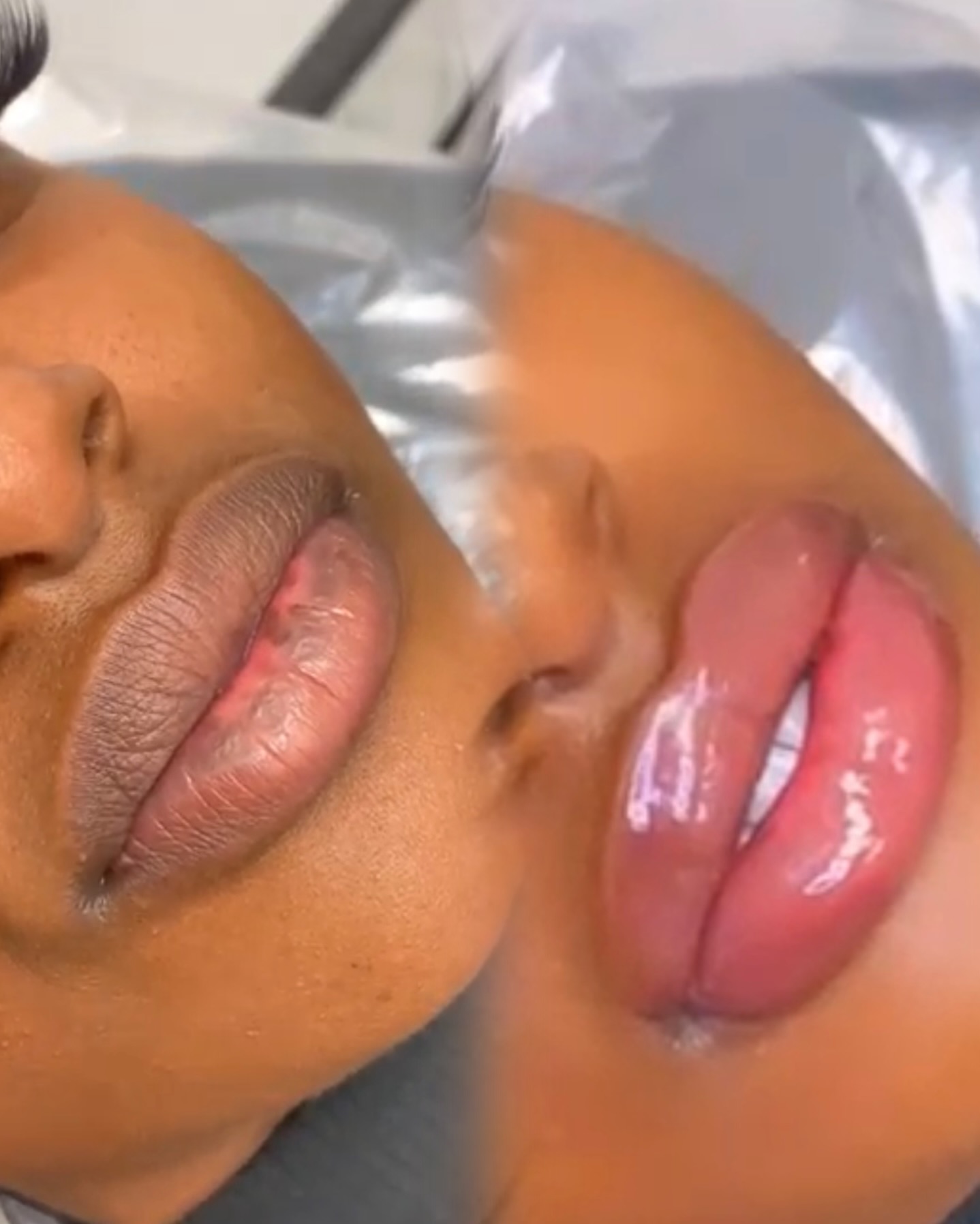 Professional aesthetic procedure being performed at The Bomb Beauty Aesthetics
