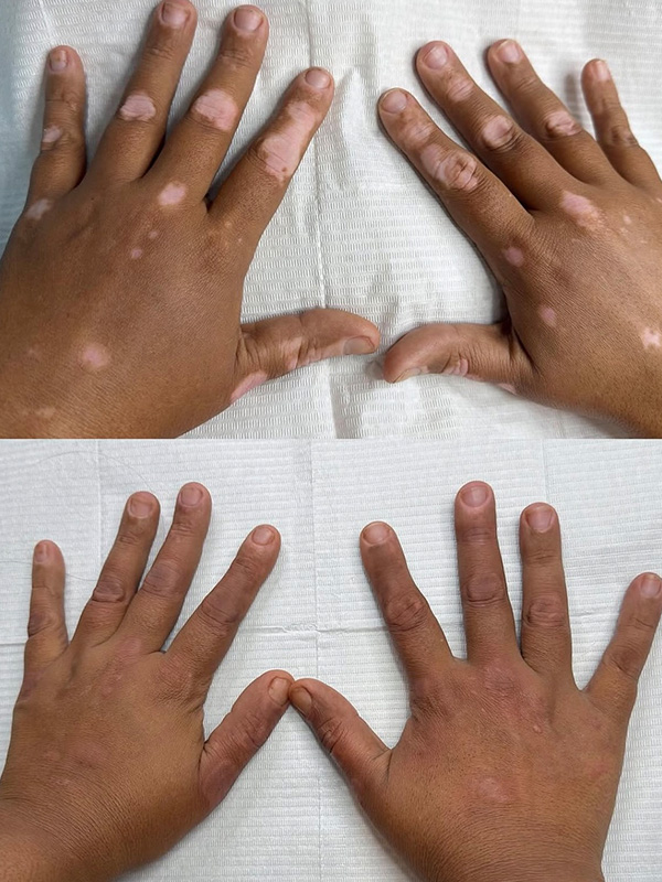 Camouflage skin tone blending treatment