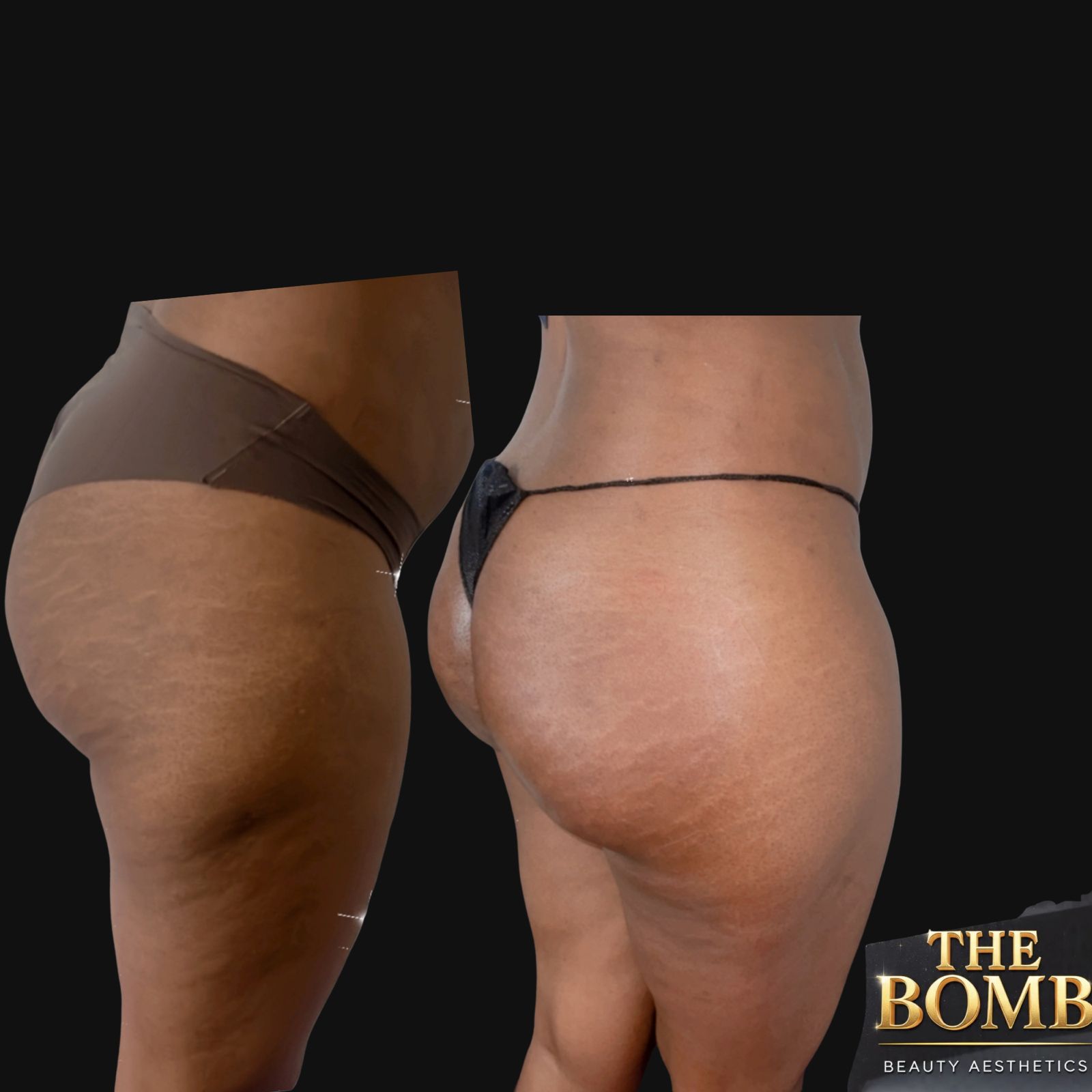 Non-surgical BBL before and after at The Bomb Beauty Aesthetics Sandton