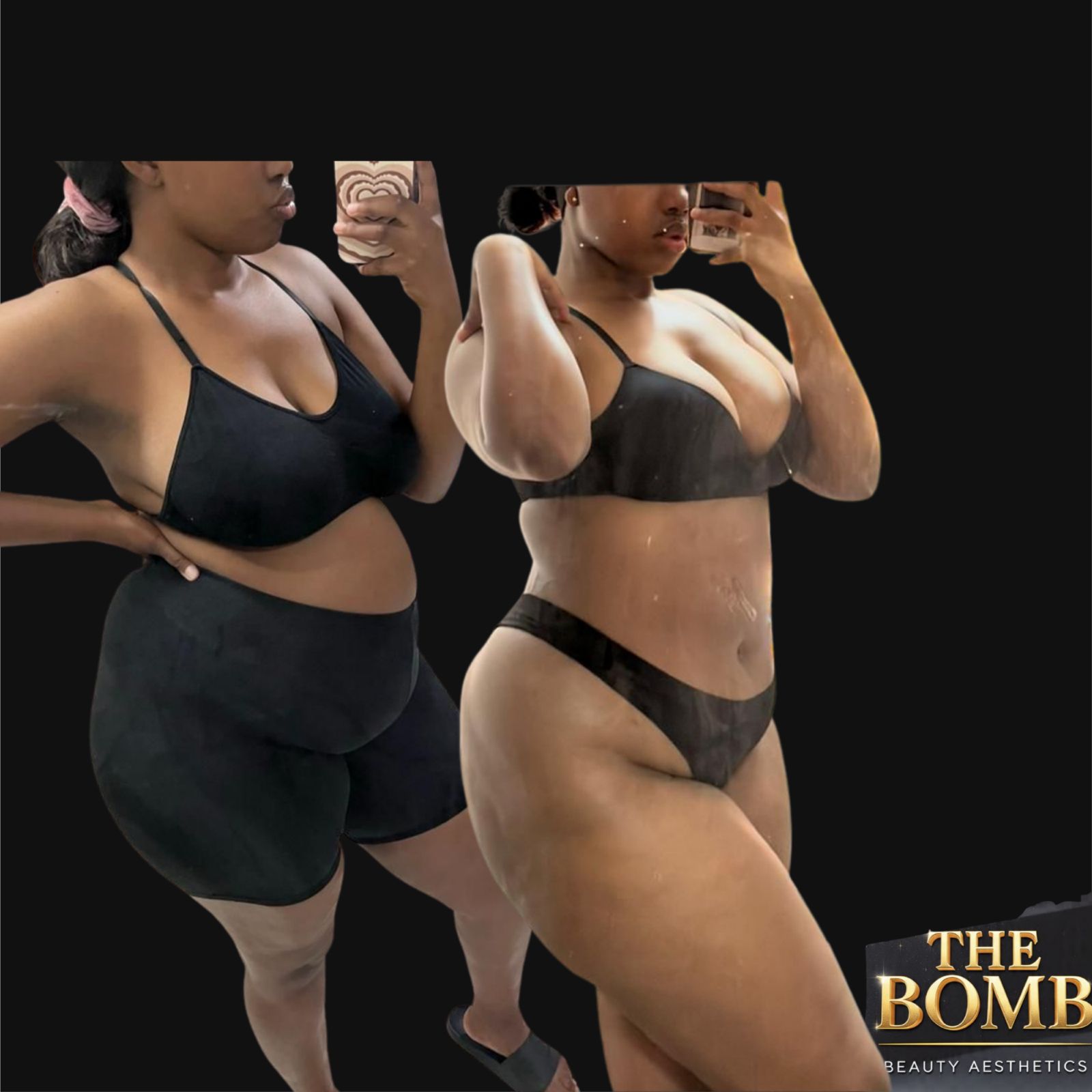 Tummy body contouring before and after at The Bomb Beauty Aesthetics Sandton