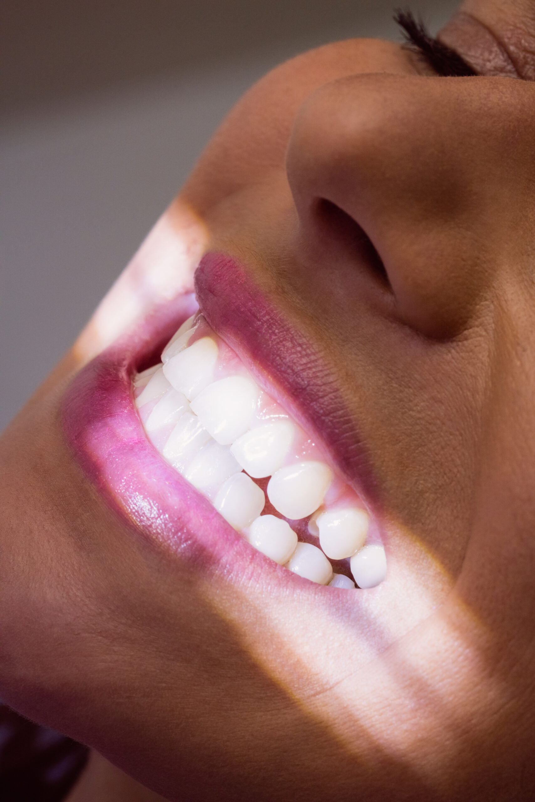 Teeth Whitening