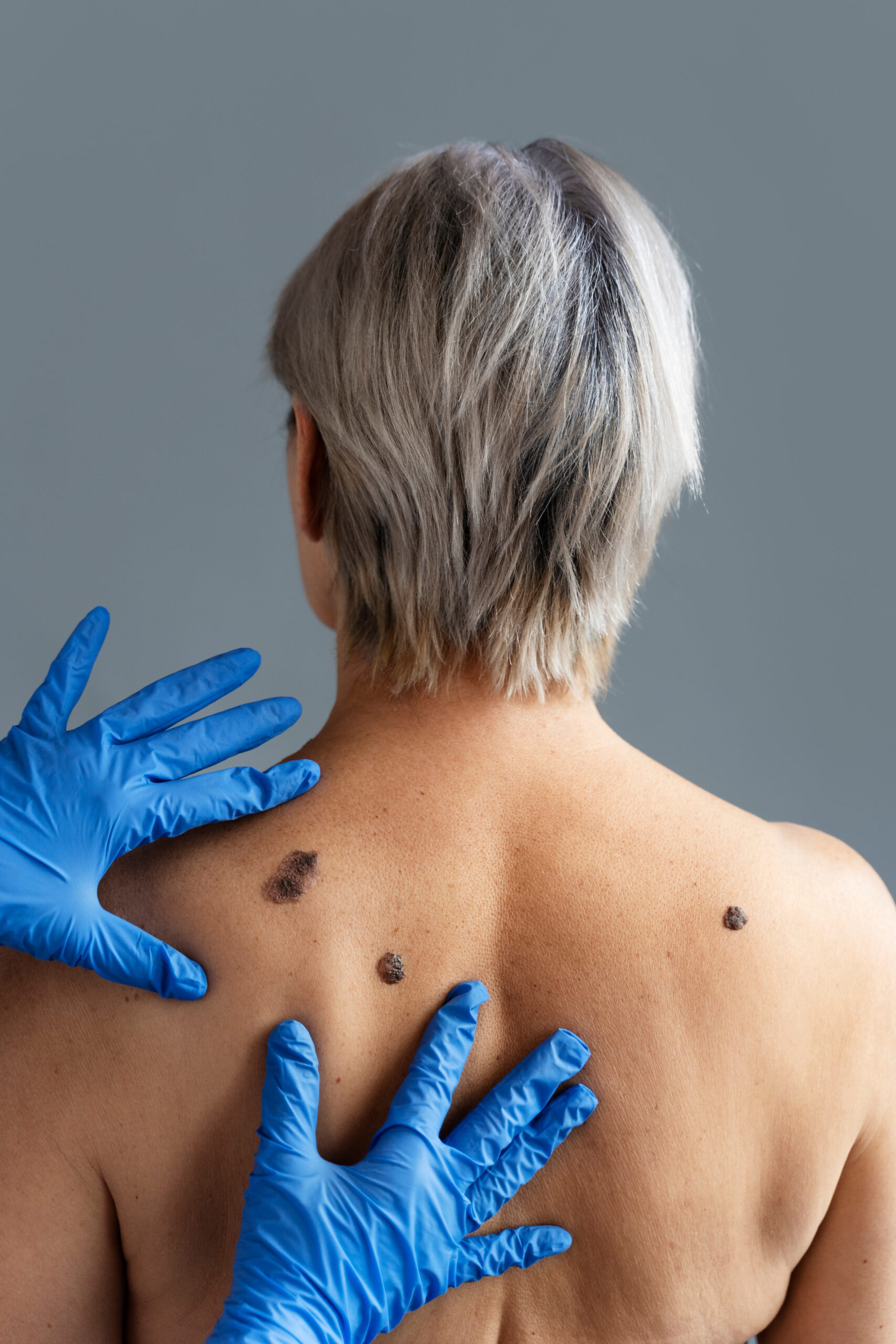 Skin Tag Removal