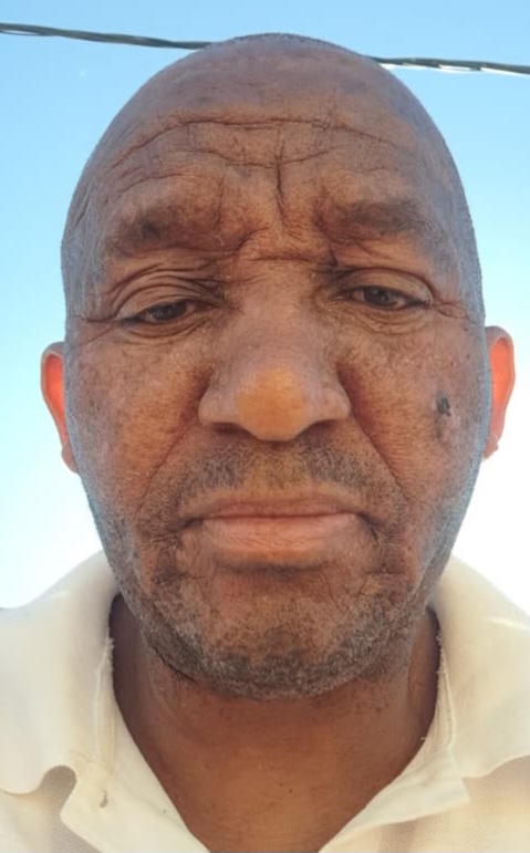 Skin Tag Removal After