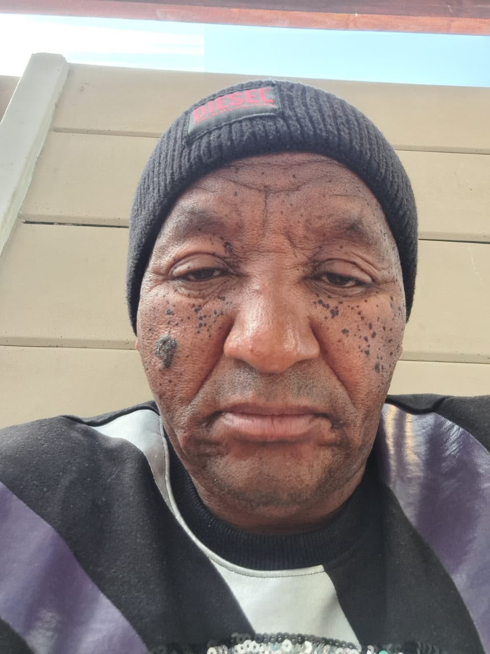 Skin Tag Removal Before