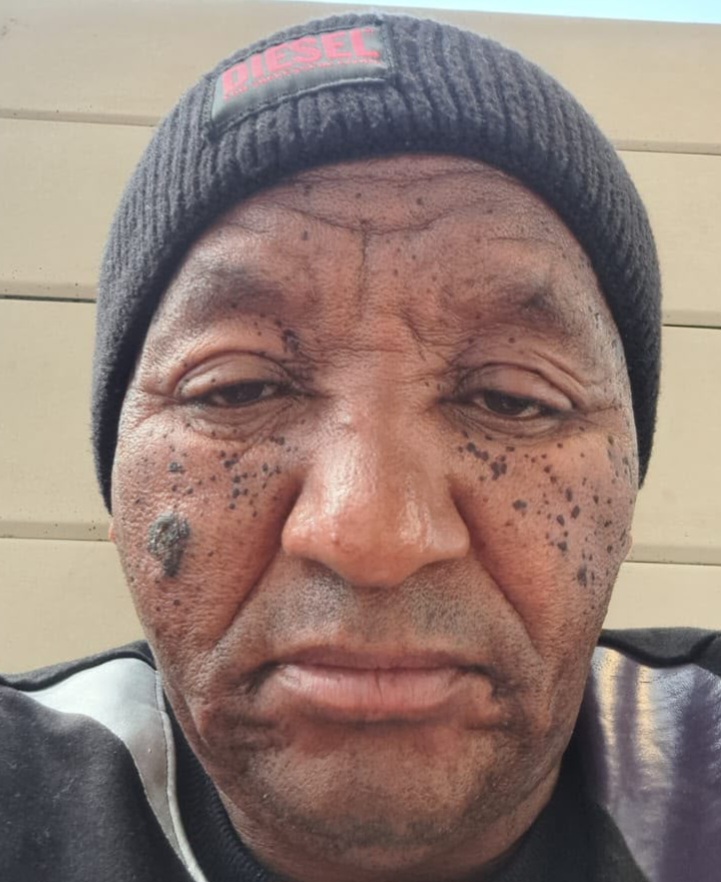 Skin Tag Removal Before