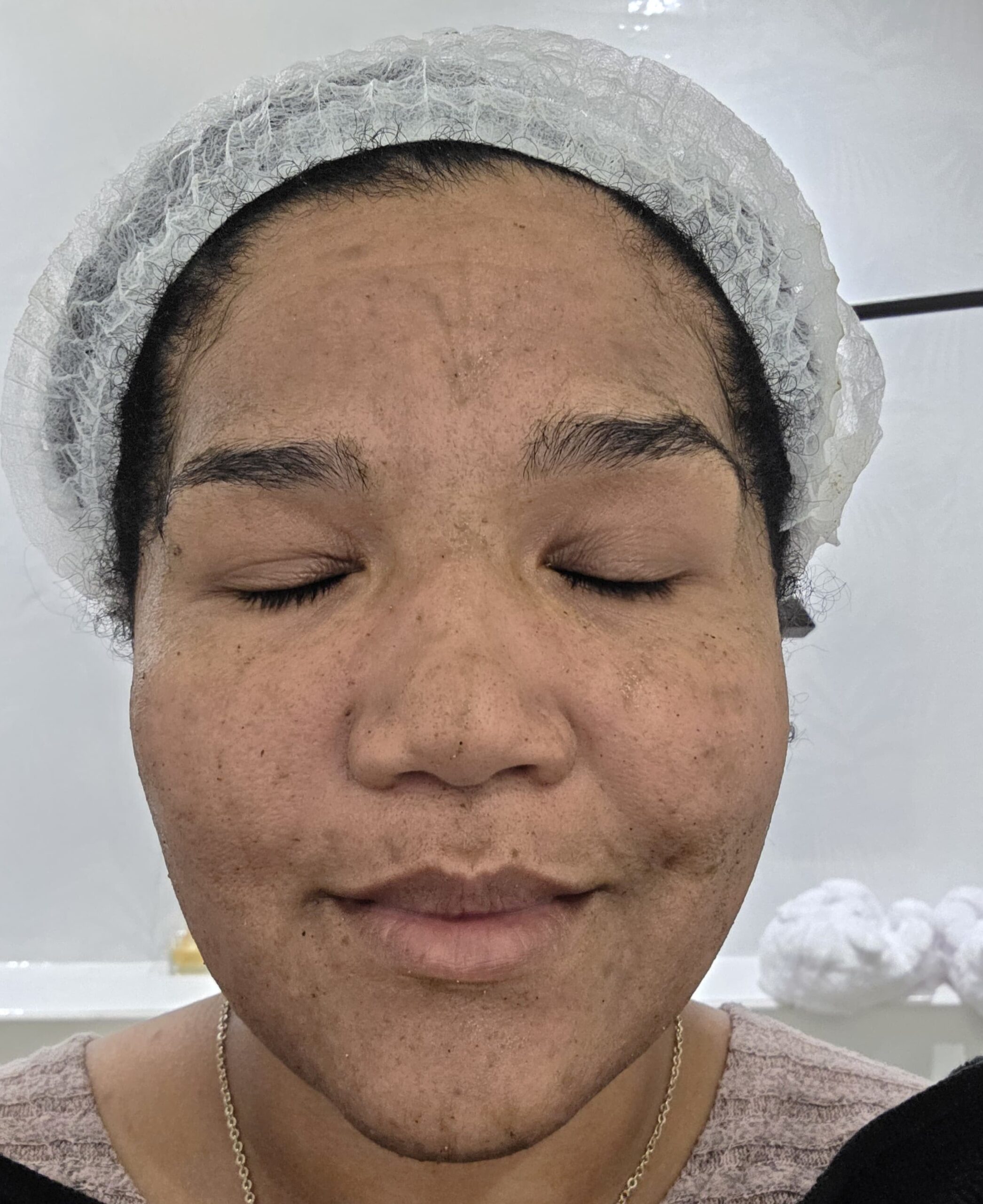 Algae Peel Before
