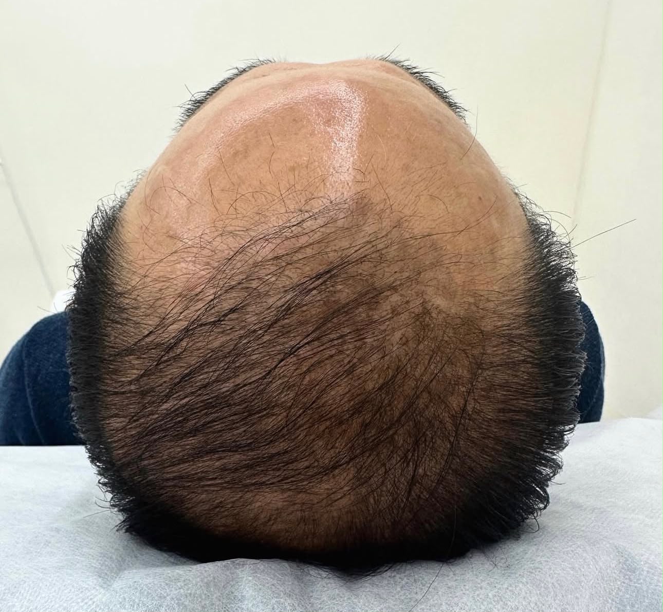 Before &mdash; Scalp Micropigmentation