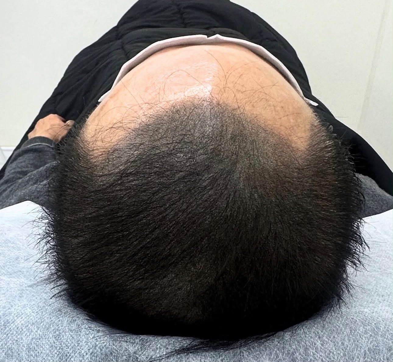 After &mdash; Scalp Micropigmentation