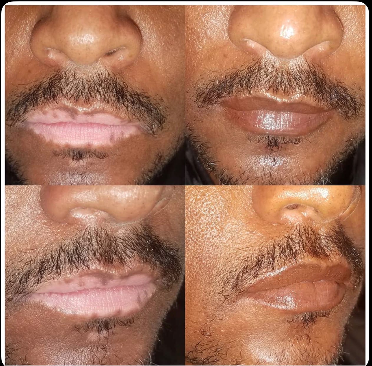 After &mdash; Lip Blush