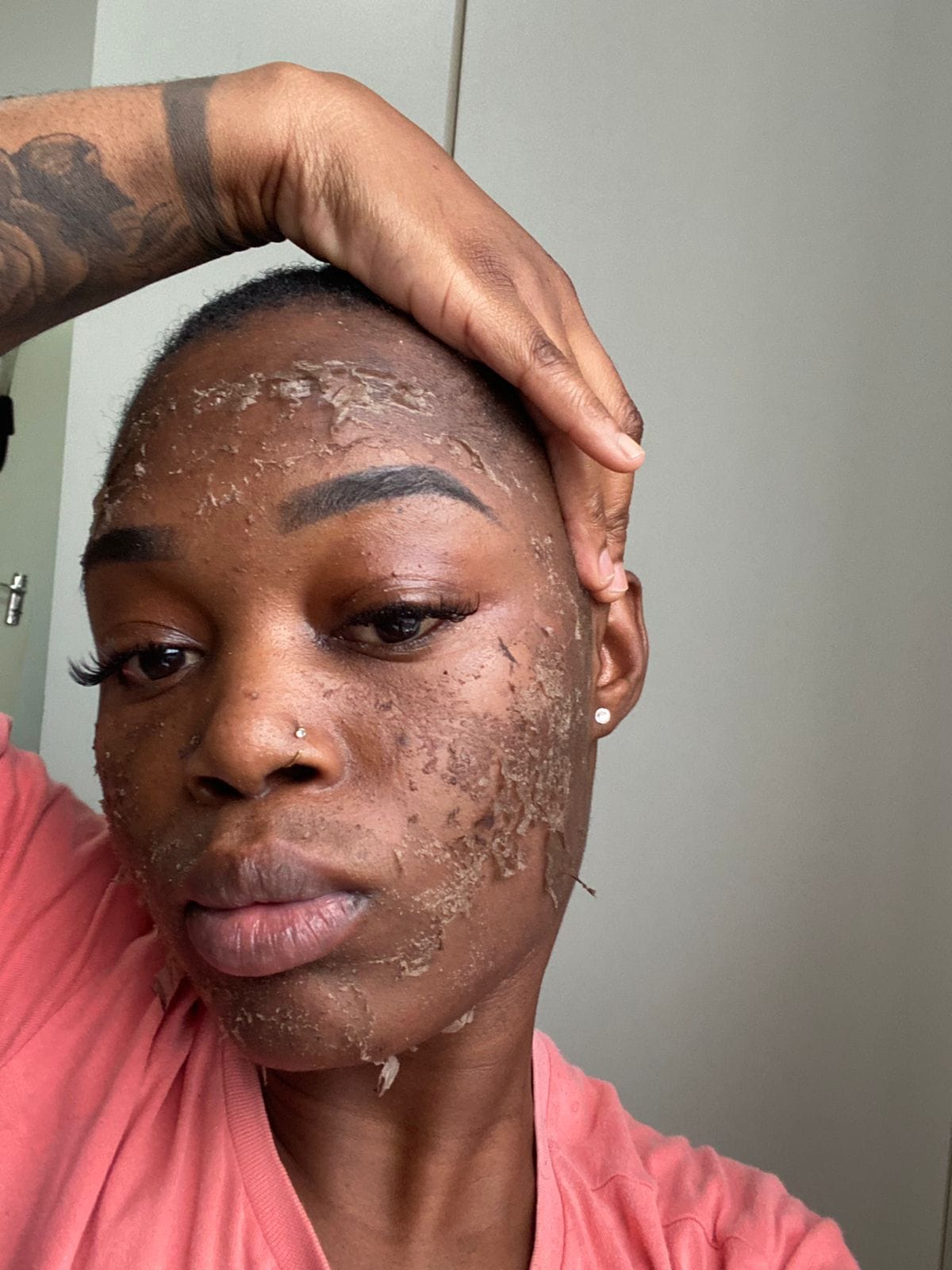 Before &mdash; Algae Peel Stretch Marks