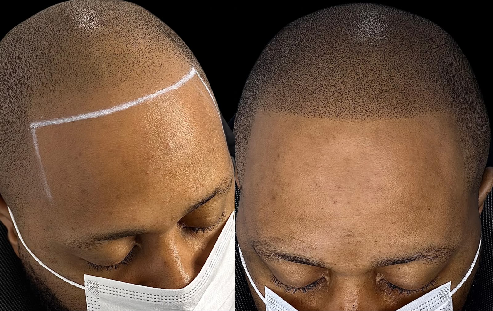 Scalp Micropigmentation