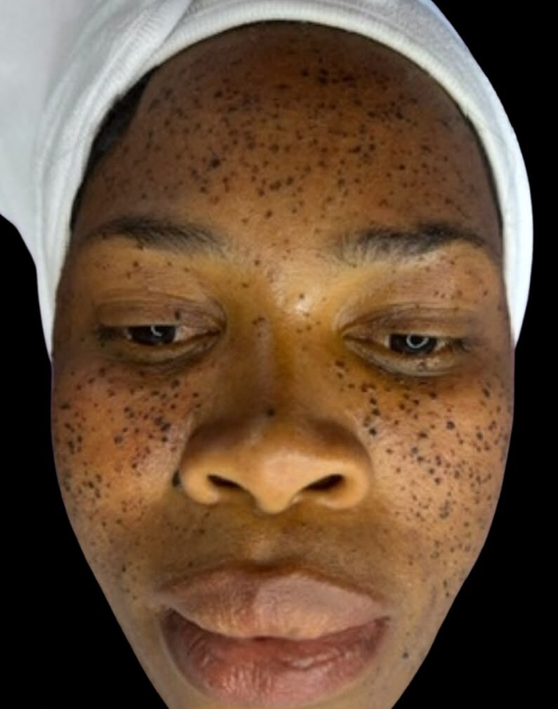 Before - Skin Tag Removal
