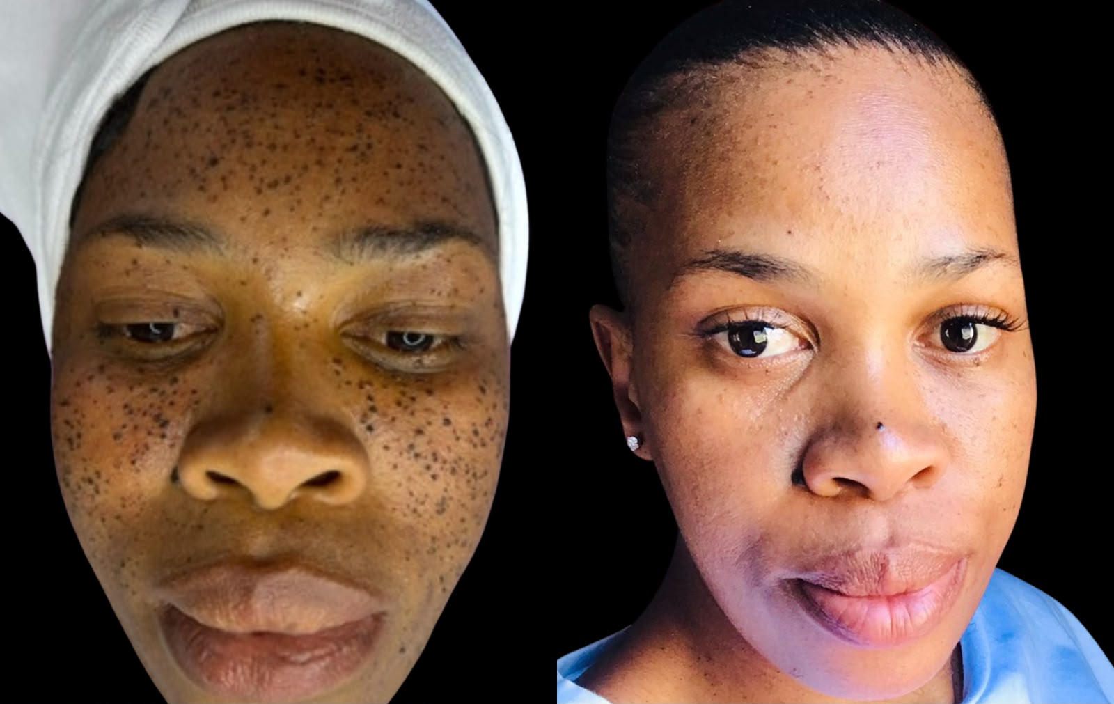 Skin tag removal treatment