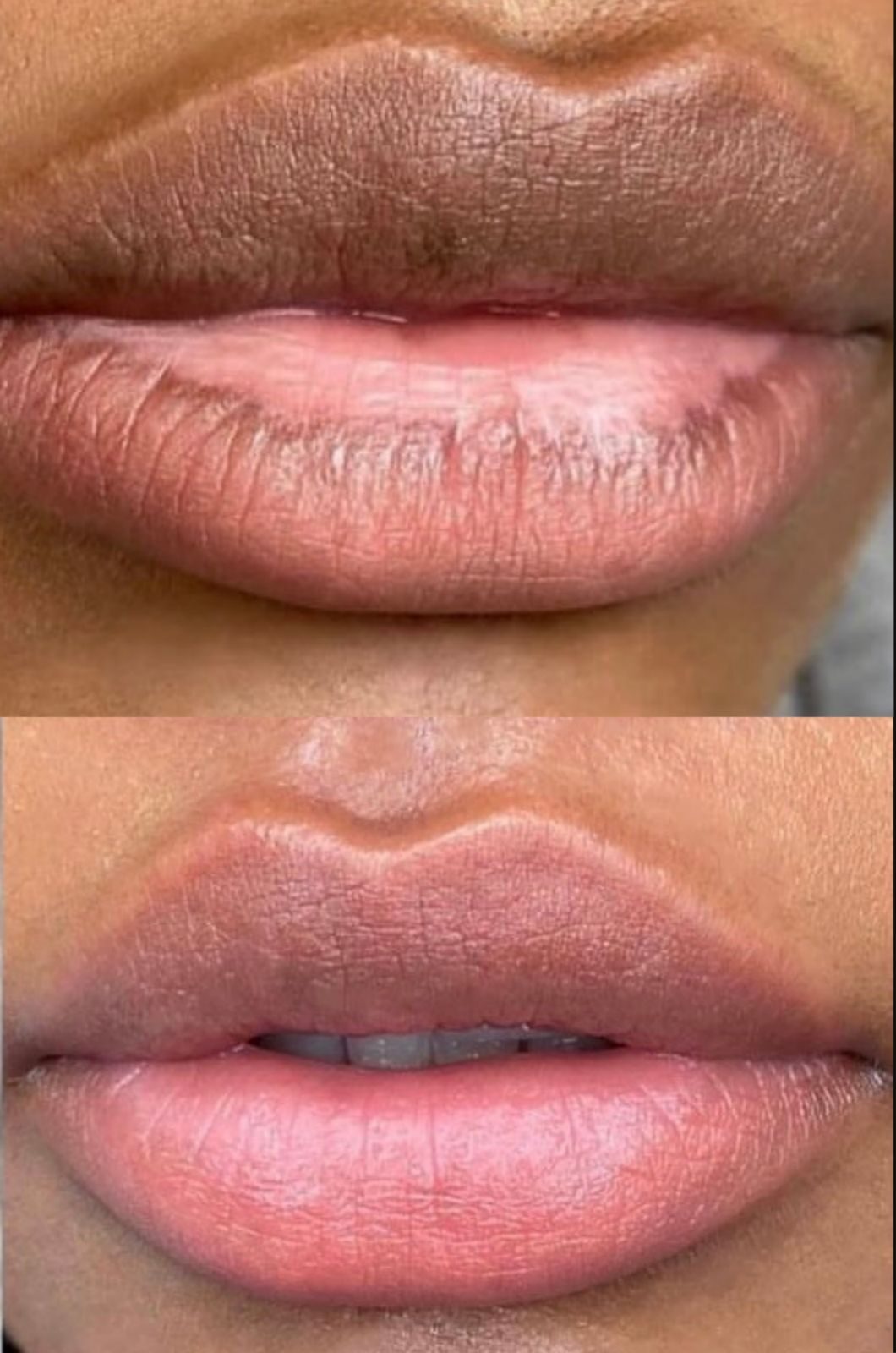 Lip Colouring - Before & After